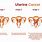 Endometrial Cancer Stages
