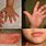 Hand Foot Mouth Disease in Children