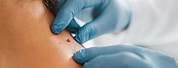 How Doctors Remove Skin Tags