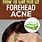 How to Get Rid of Acne On Forehead