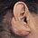 Keloid Scar Ear