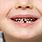 Kids with Cavities