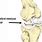 Lateral Meniscus Tear Knee Pain