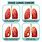 Lung Cancer Staging Stage 4