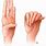 Marfan Syndrome Fingers