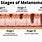 Melanoma Cancer Stages