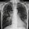 Metastatic Lung Cancer