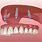 Prosthesis Teeth