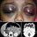 Raccoon Eyes Neuroblastoma