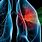 Radiation for Lung Cancer