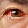 Red Eye Causes Symptoms