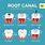 Root Canal Posters