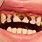 Rotten Teeth Cavity