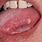 Side of Tongue Cancer