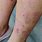 Skin Blemishes On Legs