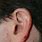 Skin Cancer On Ear Rim