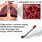 Smoking and COPD
