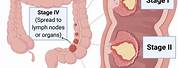 Stage 4 Small Intestine Cancer