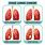 Stages of Lung Cancer