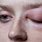 Swollen Under Eye Allergy