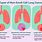 Types of Lung Cancer Tumors