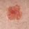 White Spots On Skin Cancer
