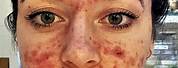 Women Severe Acne Scars