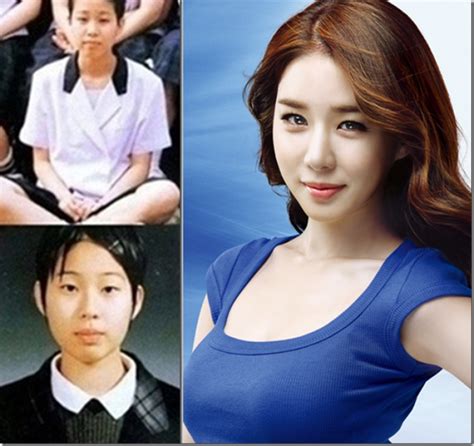 Korean Celebrities Before And After Surgery