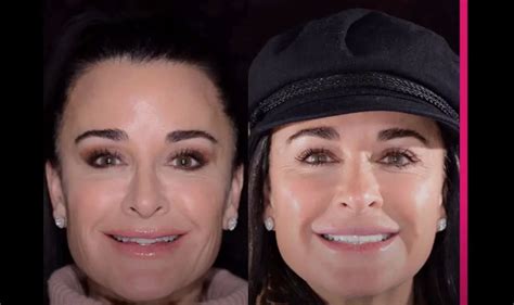Kyle Richards New Teeth Before And After