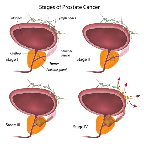 Lymph Nodes Prostate Cancer Prognosis