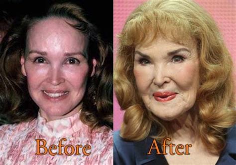 Mary Crosby Plastic Surgery Before And After