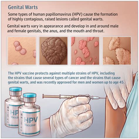 Normal Female Genital Warts
