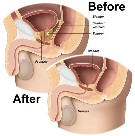 Prostatectomy Procedure