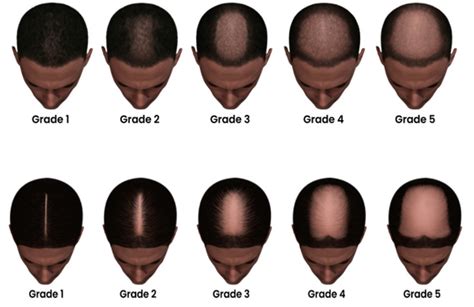 Signs Of Balding