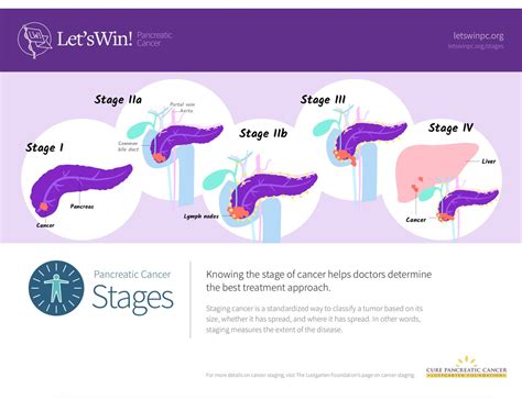 Stage 4 Pancreatic Cancer Survival